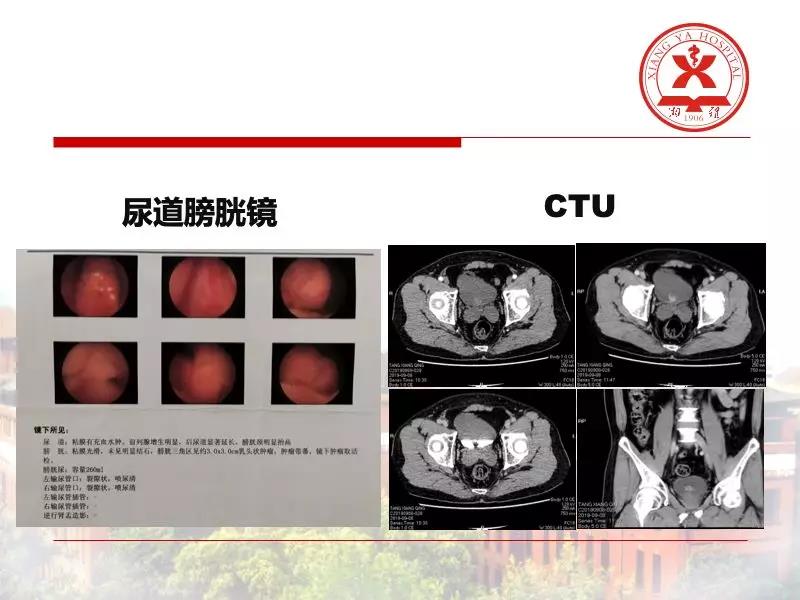 瑞柯恩培訓學院第5期,銩激光膀胱腫瘤整塊切除術-王龍