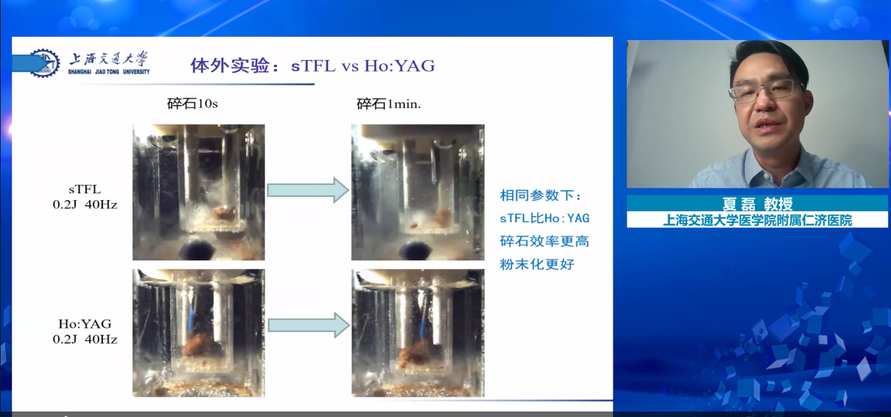 超脈沖光纖銩激光是一種安全有效的碎石激光器,Ho:YAG作為碎石激光,銩激光,醫用銩激光,瑞柯恩